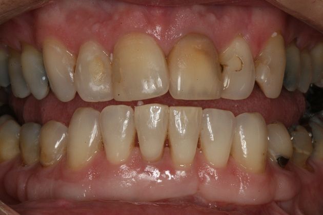 Porcelain Veneers Upper porcelain veneers - Before