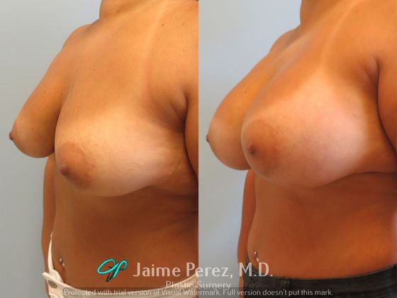 Breast Augmentation: 39-Year-Old Female: Breast Augmentation with 350cc Smooth, Round Silicone Implant - Before & After