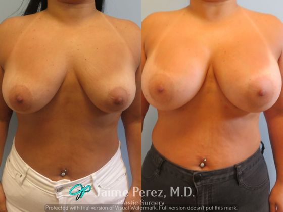 Breast Augmentation: 39-Year-Old Female: Breast Augmentation with 350cc Smooth, Round Silicone Implant - Before & After