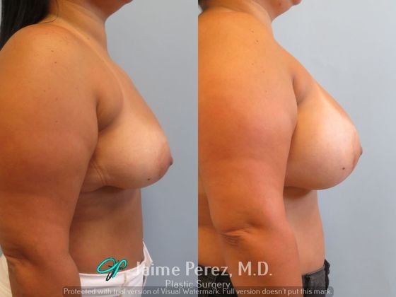 Breast Augmentation: 39-Year-Old Female: Breast Augmentation with 350cc Smooth, Round Silicone Implant - Before & After