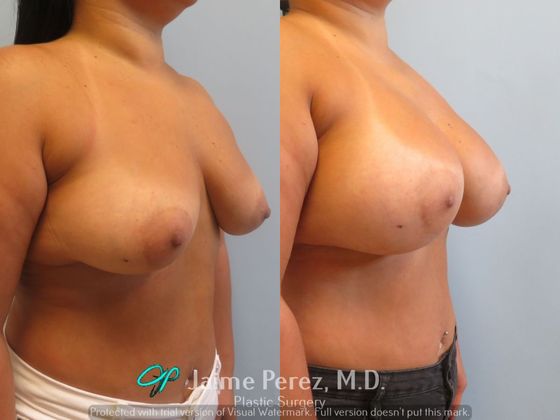 Breast Augmentation: 39-Year-Old Female: Breast Augmentation with 350cc Smooth, Round Silicone Implant - Before & After