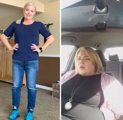 Gastric Sleeve - Click Here to See More! : Case 25 - Before & After