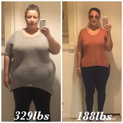 Gastric Sleeve - Click Here to See More! : Case 26 - Before & After