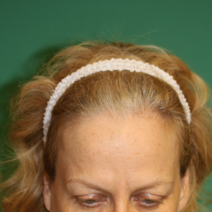 Hairline Lowering Surgery: Case 13 - Before