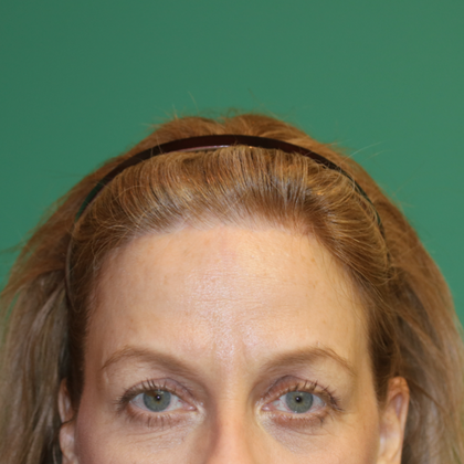 Hairline Lowering Surgery: Case 13 - After