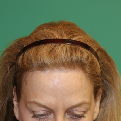 Hairline Lowering Surgery: Case 13 - After