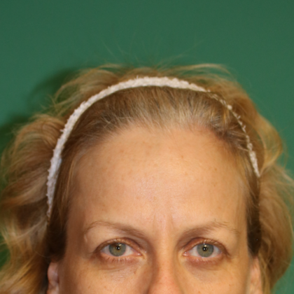 Hairline Lowering Surgery: Case 13 - Before