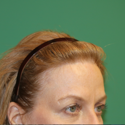 Hairline Lowering Surgery: Case 13 - After