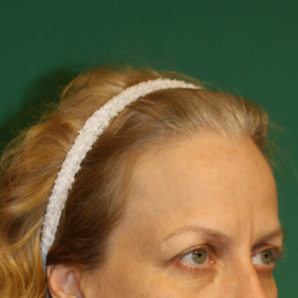 Hairline Lowering Surgery: Case 13 - Before