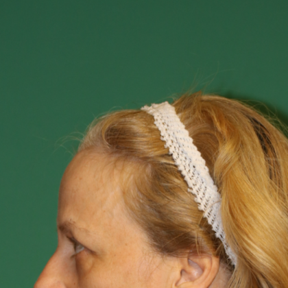 Hairline Lowering Surgery: Case 13 - Before