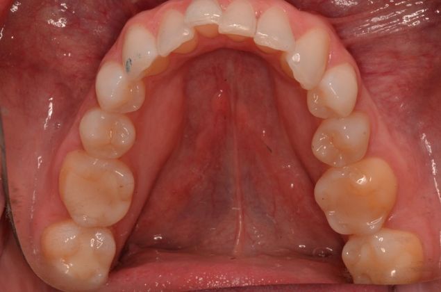 Invisalign: Case 9 - Before
