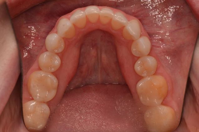 Invisalign: Case 9 - After