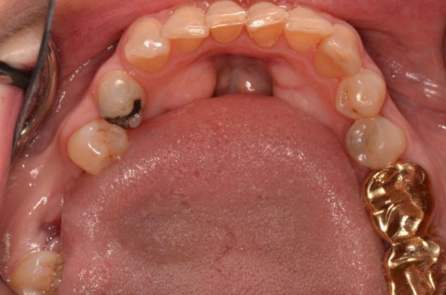Dental Implants Case 26 - Before