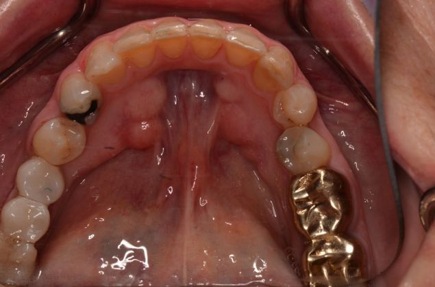 Dental Implants Case 26 - After
