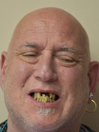 Teeth in a Day Howard - Before