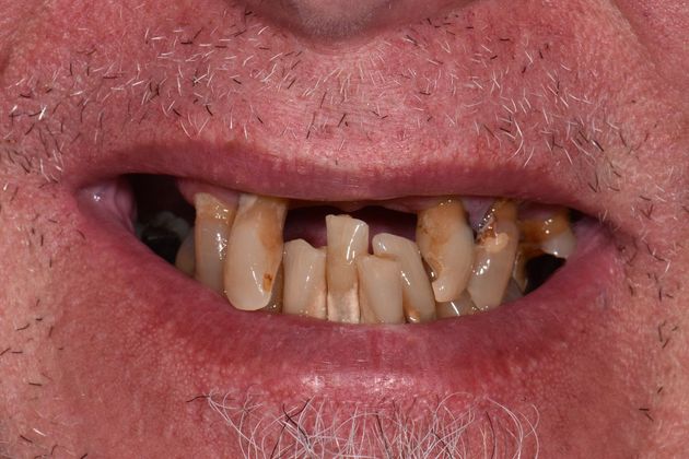Teeth in a Day: Howard - Before
