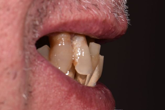 Teeth in a Day: Howard - Before