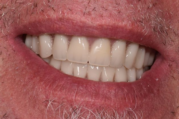 Teeth in a Day: Howard - After