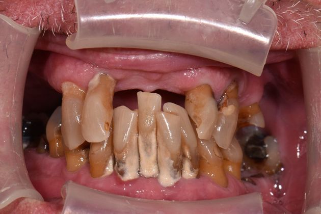 Teeth in a Day: Howard - Before