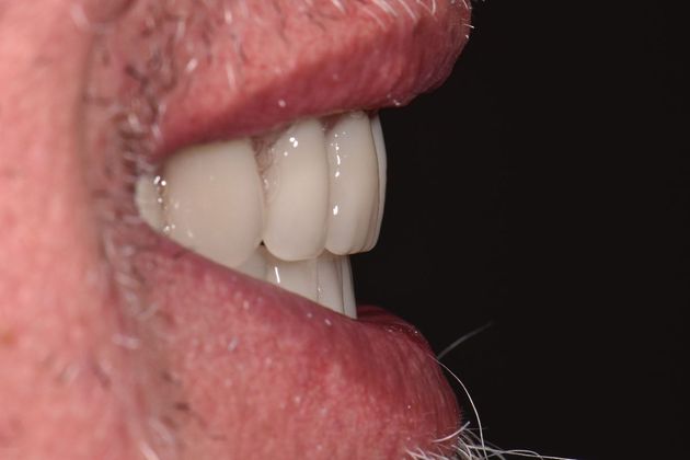 Teeth in a Day: Howard - After