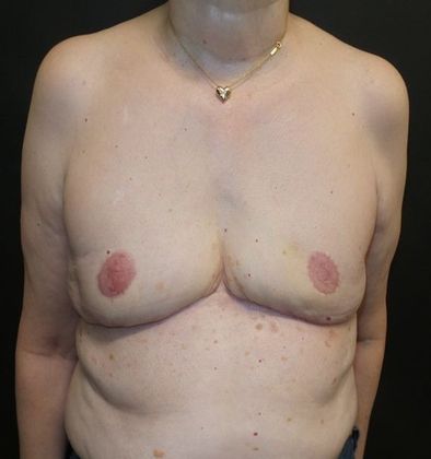 Goldilocks Breast Reconstruction Case 1 - After