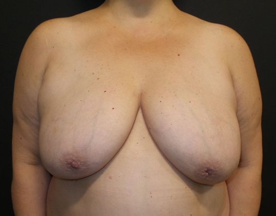Goldilocks Breast Reconstruction Case 2 - Before