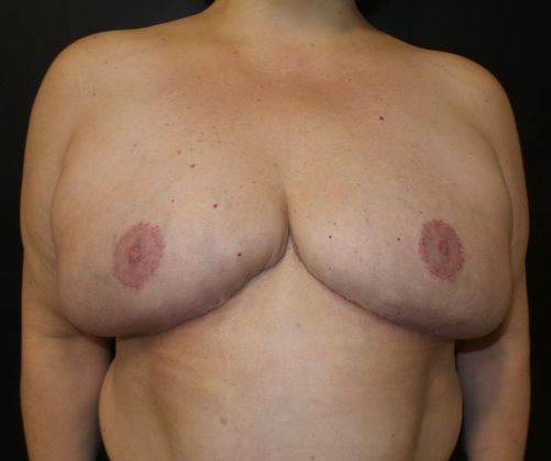 Goldilocks Breast Reconstruction Case 2 - After