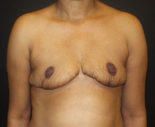 Goldilocks Breast Reconstruction Case 3 - After