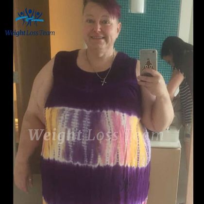 Gastric Bypass Case 3 - Before