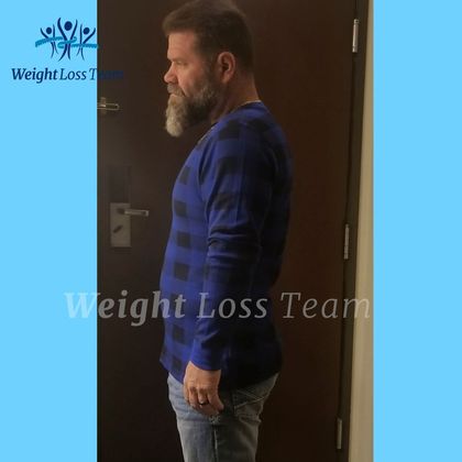 Gastric Sleeve Case 8 - After