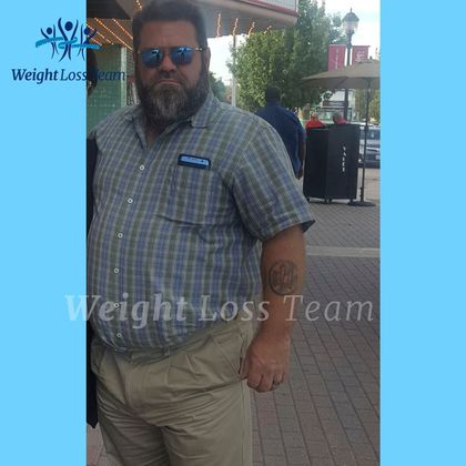 Gastric Sleeve Case 8 - Before