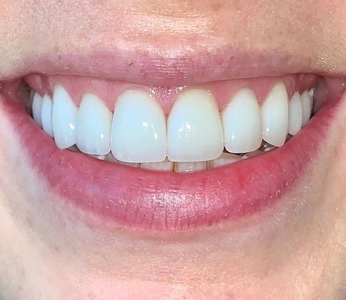 Smile Makeovers: Case 6 - After