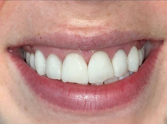 Smile Makeovers: Case 6 - Before