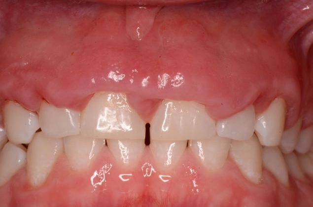 Gum Lift or Crown lengthening Case 2 - Before