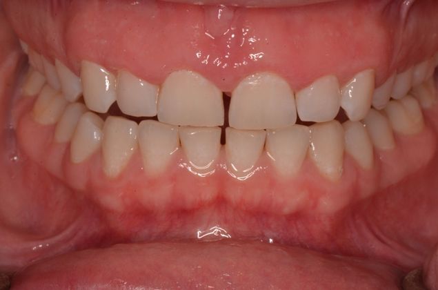 Gum Lift or Crown lengthening Case 2 - After