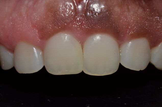 Discolored gums Case 1 - Before