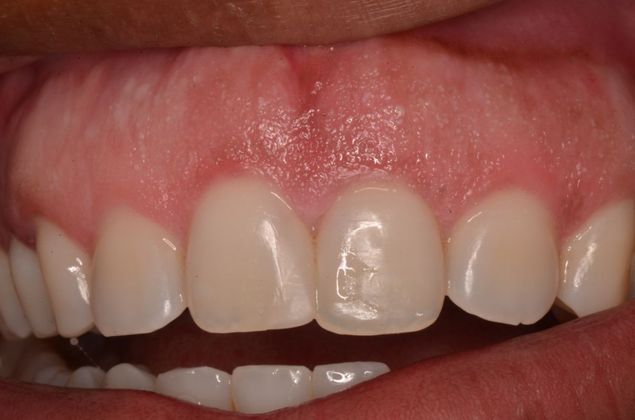 Discolored gums Case 1 - After