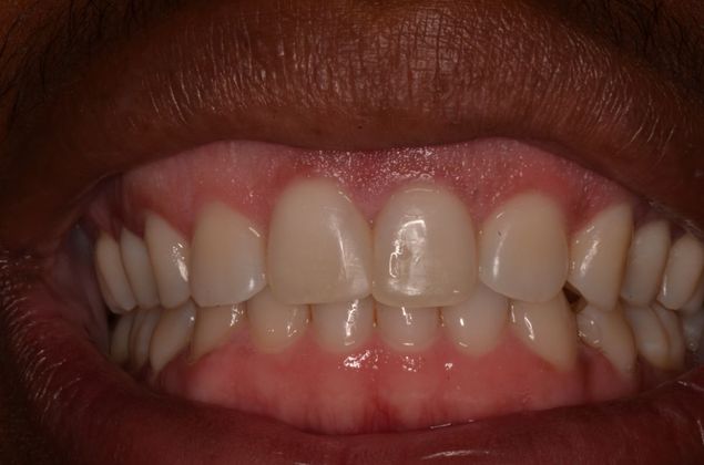 Discolored gums: Case 1 - After