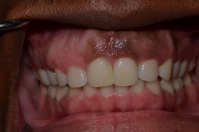 Discolored gums: Case 1 - Before