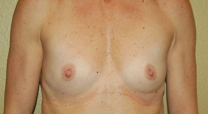 Breast Augmentation Case 547 - Before