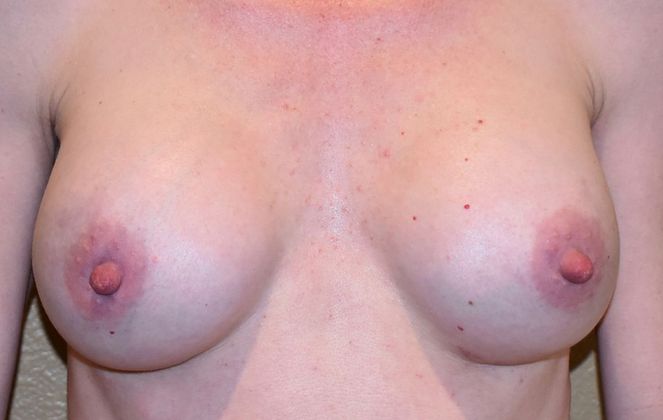 Breast Augmentation Case 543 - After