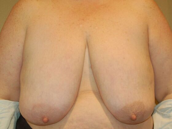 Breast Reduction Case 65 - Before