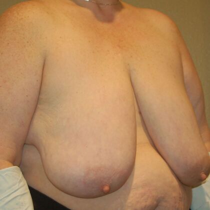 Breast Reduction: Case 65 - Before