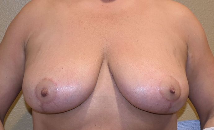 Breast Reduction Case 66 - After