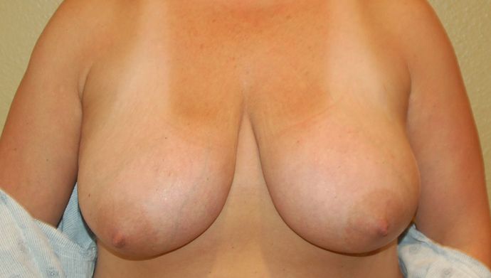 Breast Reduction Case 66 - Before