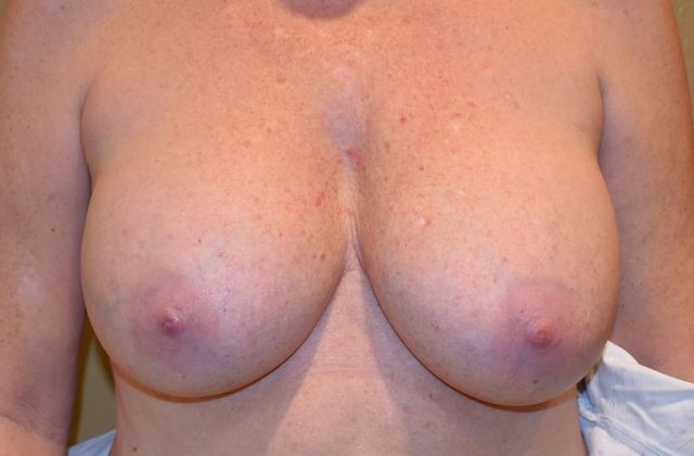 Breast Augmentation w/ Lift Case 259 - Before