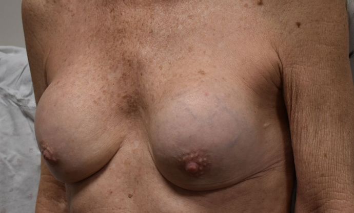 Breast Revision: Case 110 - Before