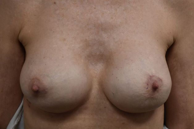 Breast Revision: Case 110 - After