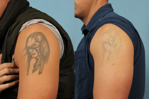 Everything You Need To Know About Tattoo Removal Before And After   Large Image 1559593401 