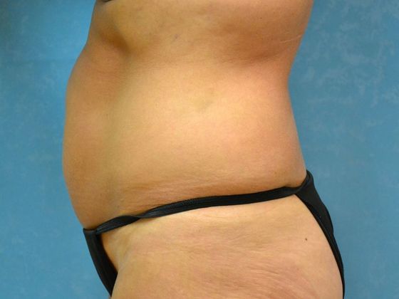 Liposuction: Case 1529- Monclova, OH - Before